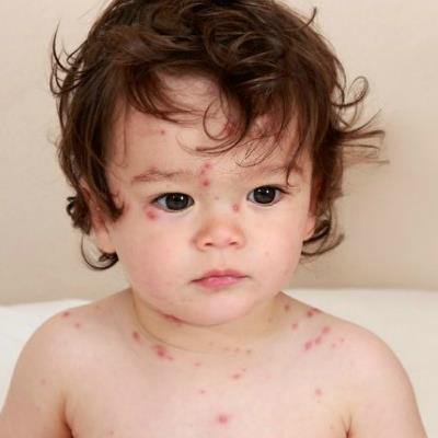 "Bàng hoàng" trước những biến chứng cực nguy hiểm của bệnh sởi ở trẻ nhỏ mà ít ai biết