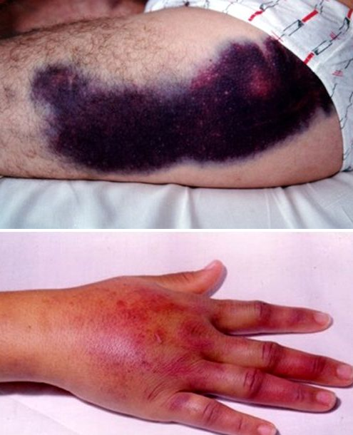  
Vết thương do sâu Lonomia obliqua gây ra - Ảnh: Pinterest