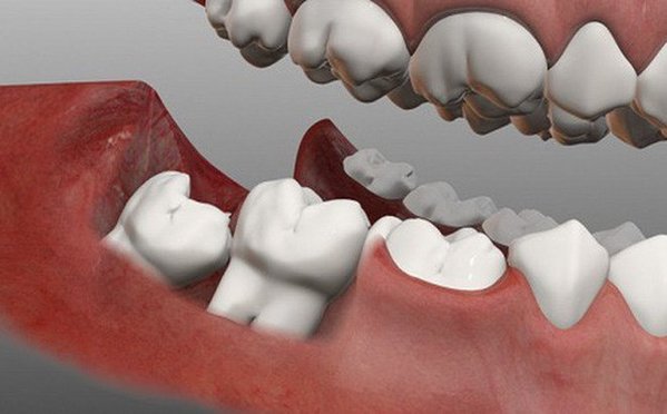  
Răng khôn nếu không xử lý kịp thời có thể ảnh hưởng tới sức khỏe, nghiêm trọng hơn là nguy hiểm tính mạng. (Ảnh minh họa: Vinmec)