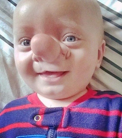 Mắc căn bệnh hiếm gặp, cậu bé mang chiếc mũi đặc biệt như nhân vật Pinocchio - Ảnh 2