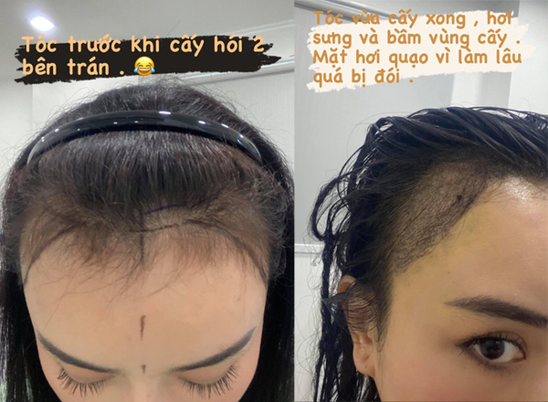        Angela Châu khoe ảnh đi cấy tóc tại Thái Lan. (Ảnh: Ngôi sao)