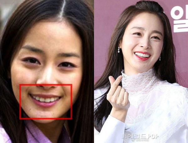 Loạt sao Hàn chỉnh răng: Kim Tae Hee \