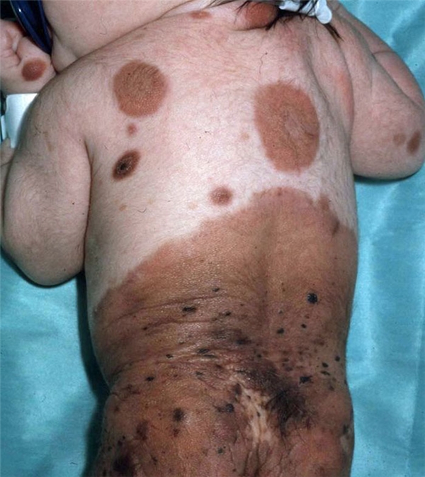 
Alba sinh ra với hơn 500 vết bớt trên cơ thể do mắc phải một căn bệnh hiếm gặp.