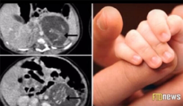 
Hình ảnh chụp X-quang hai bào thai song sinh.