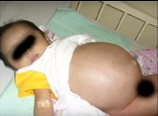 
Cô bé này là trường hợp mang thai sớm nhất trên thế giới.