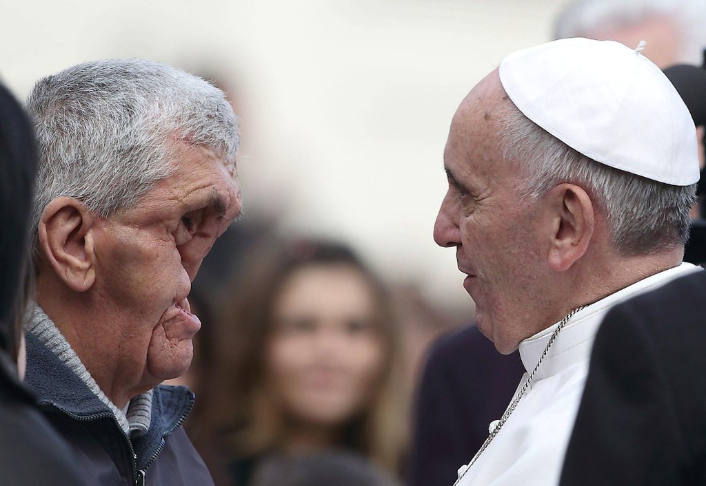 
Không lâu sau đó, Giáo hoàng đã trò chuyện và cầu Chúa ban phước lành cho một người đàn ông
với khuôn mặt bị biến dạng.