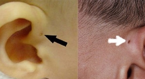 
Lỗ nhỏ đặc biệt nơi vành tai