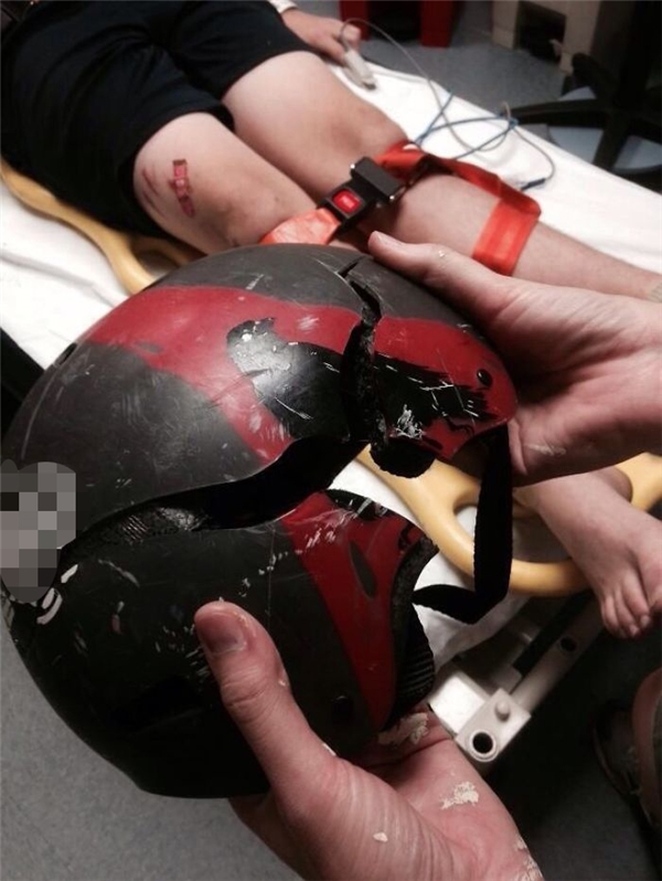 
Sau tai nạn ngã đập đầu, nạn nhân đã được đưa đi cấp cứu còn chiếc mũ thì nứt toác như thế này đây.
