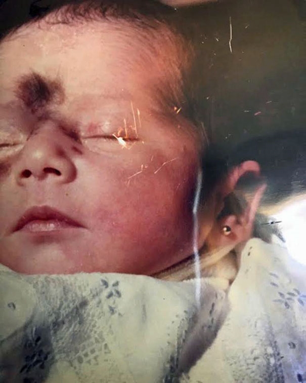 Cuộc sống khó tin sau 24 năm của cô gái sinh ra đã có vết bớt trên mặt
