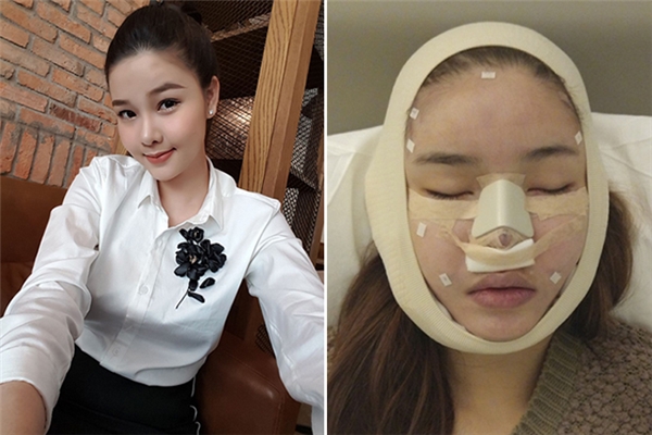 
Không lâu sau, hình ảnh Kỳ Hân tân trang vẻ ngoài tại Hàn Quốc được cộng đồng mạng chia sẻ liên tục. Sau đó, nữ người mẫu mới thừa nhận đã sửa mũi và làm lại răng cho tự tin hơn. Kỳ Hân đã chi khoảng 250 triệu đồng cho lần chỉnh sửa này.