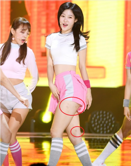 
Chaeyeon (DIA) lộ rõ những vết bầm tím ở chân khi biểu diễn trên sân khấu.