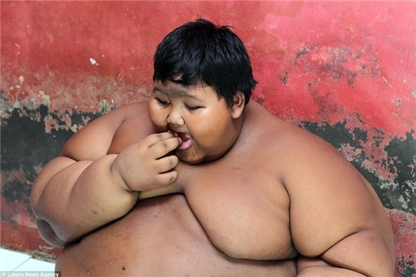 Cậu bé 11 tuổi nặng gần 200kg phải phẫu thuật dạ dày để giảm cân