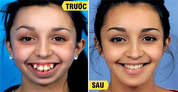 15 trường hợp chứng minh niềng răng có thể 