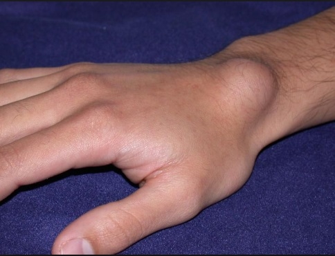 
Những cục u xuất hiện ở cổ tay hay khớp ngón vẫn thường bị xem thường.