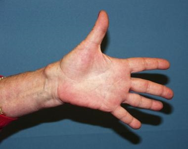 
Các hạt, u có kích cỡ như một viên bi thường xuất hiện ở bề mặt cổ tay, khớp ngón tay, khớp bàn chân,...