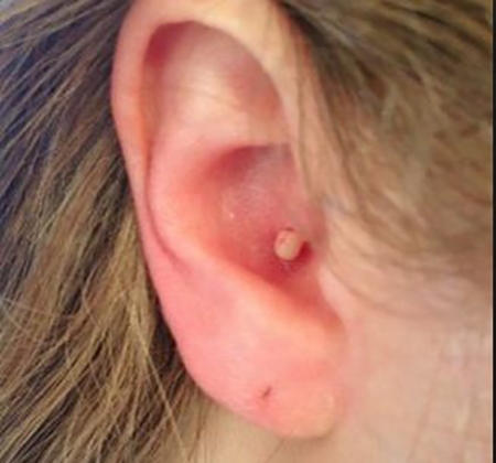 
Nếu bạn bị mọc mụn ở hai bên lỗ tai, đó là dấu hiệu cho thấy thận của bạn đang hoạt động không tốt.