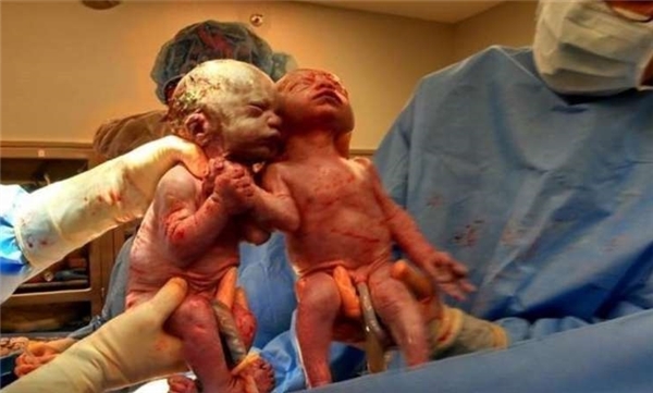 Cặp song sinh nắm chặt tay nhau khi chào đời ngày ấy bây giờ ra sao?
