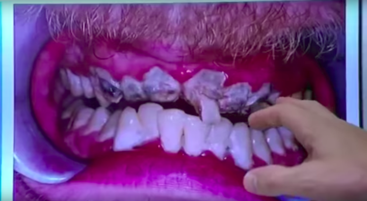 
Hàm răng hỏng không thể nào kinh khủng hơn là kết quả không vệ sinh liên tục suốt 20 năm