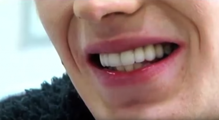 
Hàm răng mới giúp cuộc đời của chàng trai lười đánh răng bước sang trang mới.
