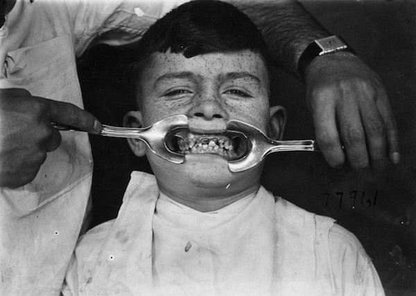 
Khi khám răng cần há miệng ra thật to nhưng nhiều người không giữ được lâu, vì thế, họ dùng dụng cụ banh miệng để hỗ trợ. Nếu đứa trẻ trong ảnh mà còn sống thì hẳn ông ta vẫn chưa quên được trải nghiệm đáng sợ này.