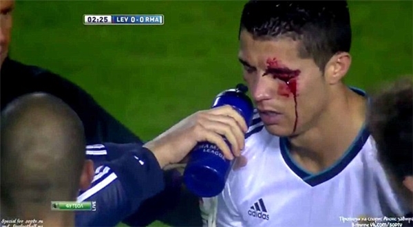 
C.Ronaldo đổ máu với vết rách trên mắt trái.