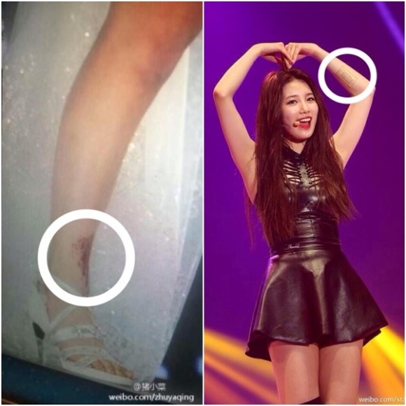 
Suzy nén đau biểu diễn với đôi chân và cánh tay bị thương sau cú ngã.