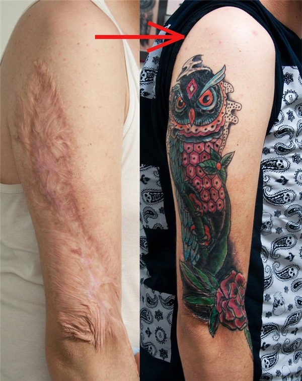 Transforming Body Imperfections into Artistic Accents with Scar Tattoos