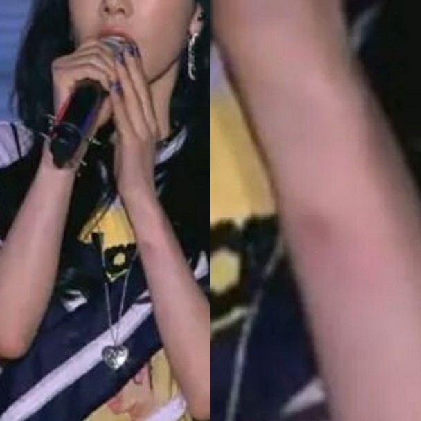 
Dù vậy nhưng fan vẫn lo lắng cho Taeyeon khi vết bầm sau sự cố vẫn còn in rõ trên tay của nữ ca sĩ. Người hâm mộ hy vọng Taeyeon nhanh chóng bình phục và ổn định tâm lý.