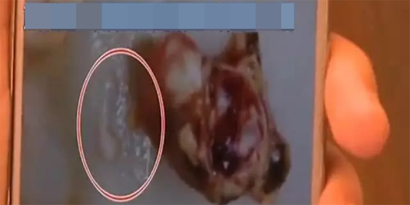 Đây là hình ảnh con giun được lấy ra sau ca phẫu thuật.