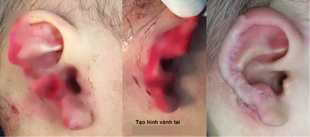 
Tai phải của cháu N. trước và sau khi phẫu thuật tái tạo da