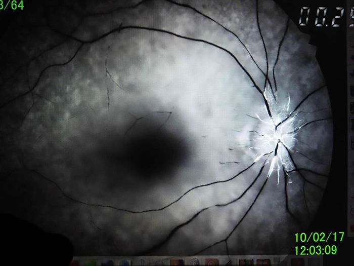 
Mắt của Wu được chẩn đoán là bị tắc nghẽn động mạch võng mạc dẫn đến mất thị lực bất ngờ.