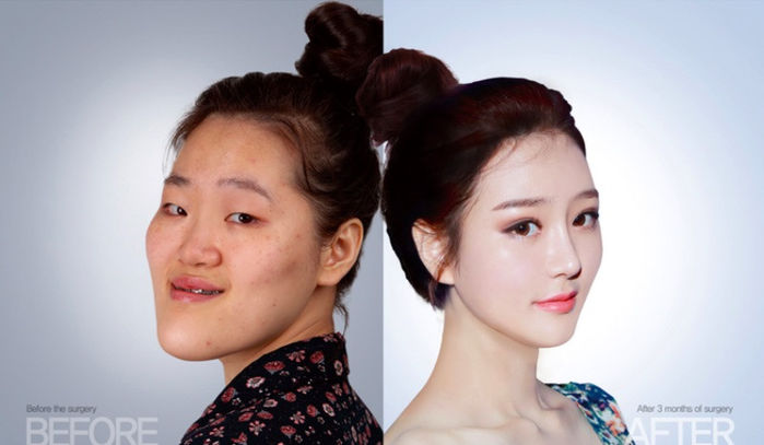 
Goo Yoon-I sở hữu vẻ đẹp hoàn hảo theo tiêu chuẩn Hàn sau khi dao kéo. Ảnh: Cinderella Plastic Surgery. 