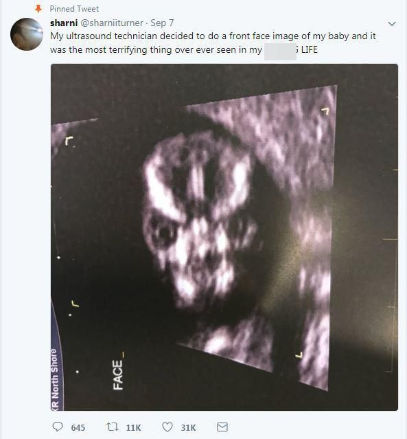 
Bức ảnh siêu âm chụp chính diện mặt thai nhi khiến nhiều người sửng sốt
