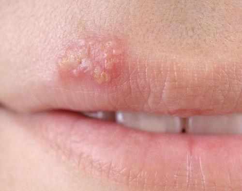 
Căn bệnh Herpes ở miệng thường do người mang virus hôn và truyền sang
