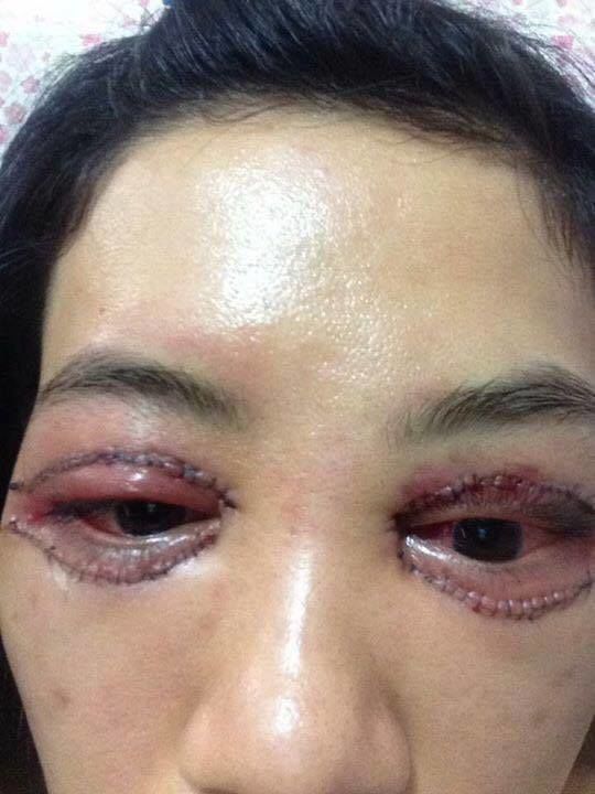 
Nữ khách hàng bị chảy máu, mắt đỏ tấy sau khi cắt mí tại spa K.T