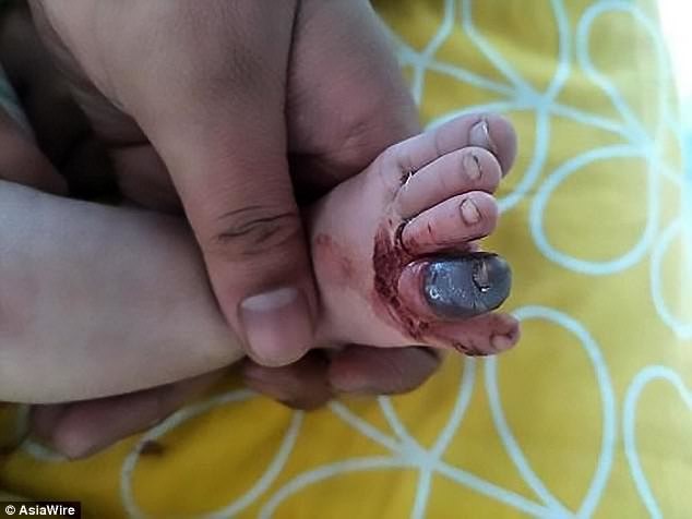 
Một ngón chân đã bị hoại tử sau khi bị sợi tóc của mẹ quấn vào làm cho máu không thể lưu thông được
