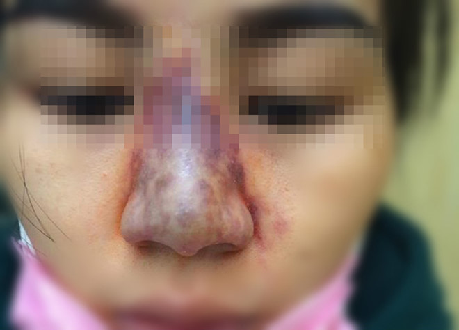 
Chị Hà suýt mất mũi vì biến chứng