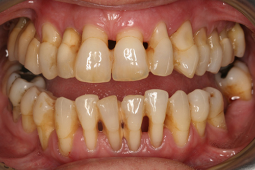 Cảnh báo: Xỉa răng bằng tăm sau khi ăn có thể khiến người dùng có nguy cơ mắc bệnh nguy hiểm