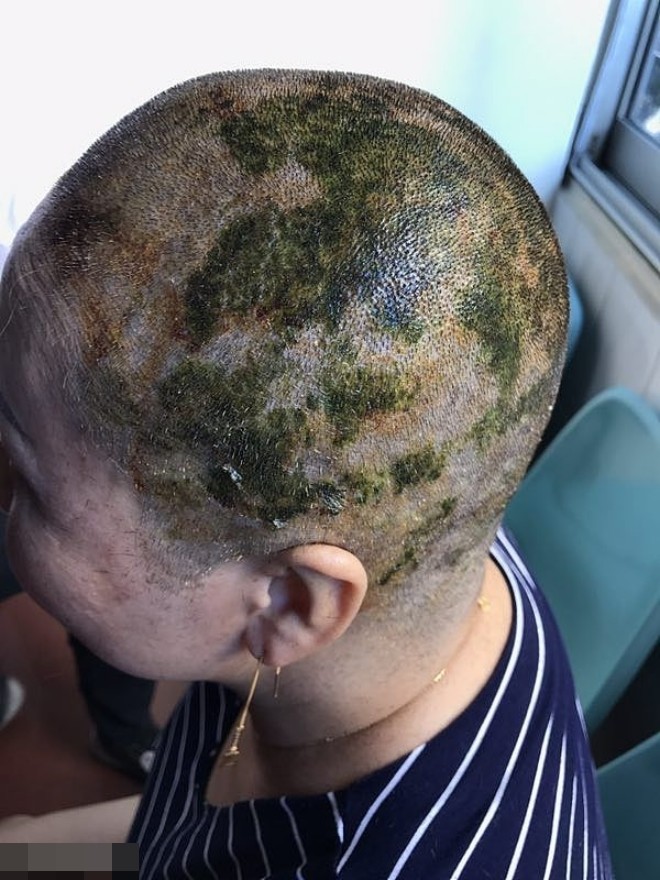
Da đầu của chị Đặng 46 tuổi bị bỏng hóa học đến 40%
