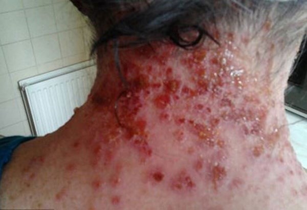 
Một bệnh nhân lở loét da do dị ứng cực mạnh với thuốc nhuộm tóc