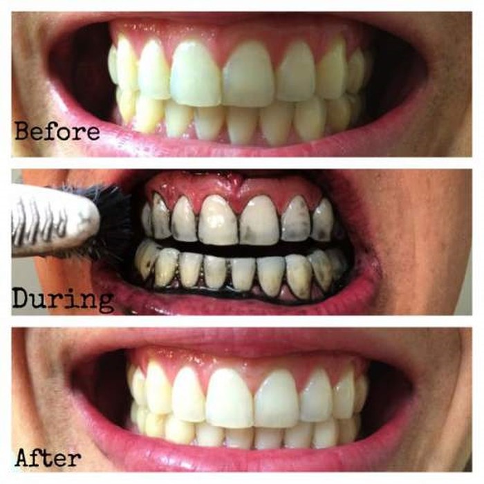 
Và đây chính là kết quả khiến bạn bất ngờ, răng trắng hơn và mùi hôi miệng cũng giảm hẳn.