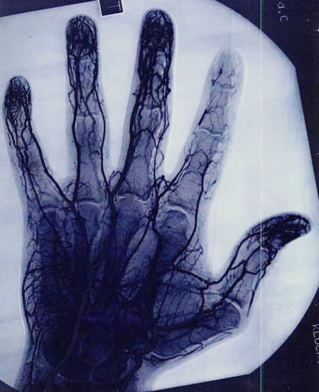 
Ảnh chụp X-quang bàn tay của một cao thủ chơi yo-yo. Hãy nhìn ngón trỏ kìa, mô mạch thần kinh cứ như thể đã tàng hình hết rồi vậy.