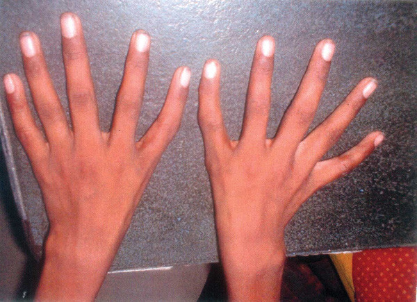 
Cụ thể là hai bàn tay của người mắc dị tật trông sẽ như thế này.