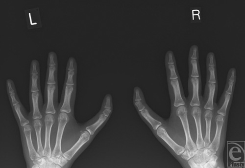 
Đốt xương thừa rất bé nhưng cũng đủ để tạo nên sự kì dị trên bàn tay.