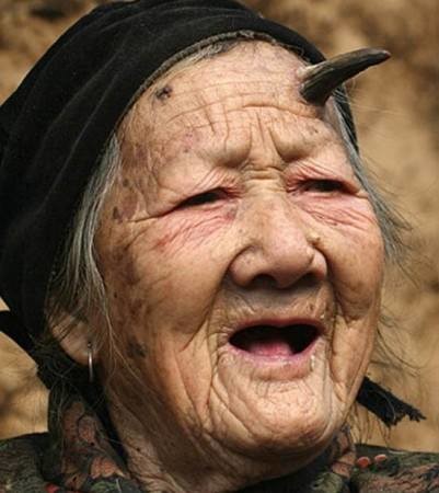 
Một cụ bà ở Trung Quốc mắc hội chứng mọc sừng da