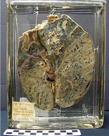 
Đây là phổi của một người bị viêm phổi. Quả thực sức tàn phá của bệnh tật thật khủng khiếp.