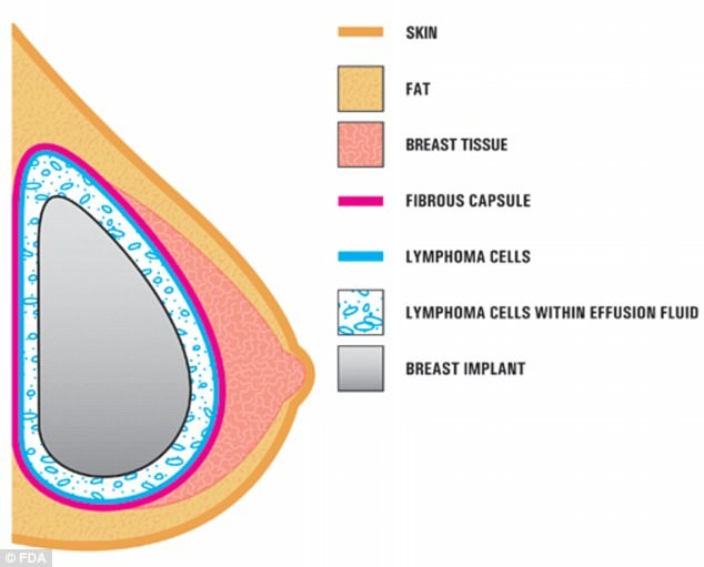 
Biểu đồ cho thấy tế bào lymphoma hình thành ở những bệnh nhân đã cấy ghép vú