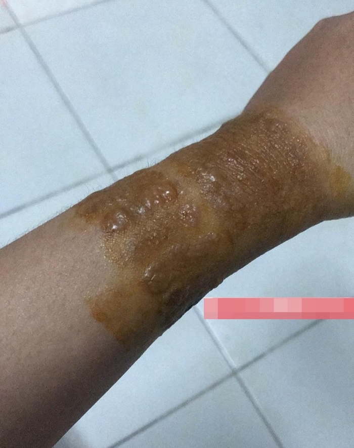 
Hình ảnh bàn tay nổi mụn nước, viêm da vì nghi đeo vòng phong thủy được đăng tải lên mạng xã hội