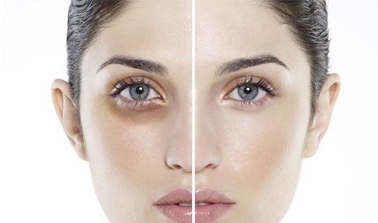 
Vùng da xung quanh mắt luôn khiến phụ nữ lo lắng bởi những dấu hiệu lão hóa sớm.