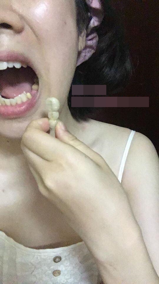 Cô gái trẻ bị rơi cả cụm răng bọc sứ chỉ vì ăn... kẹo dừa